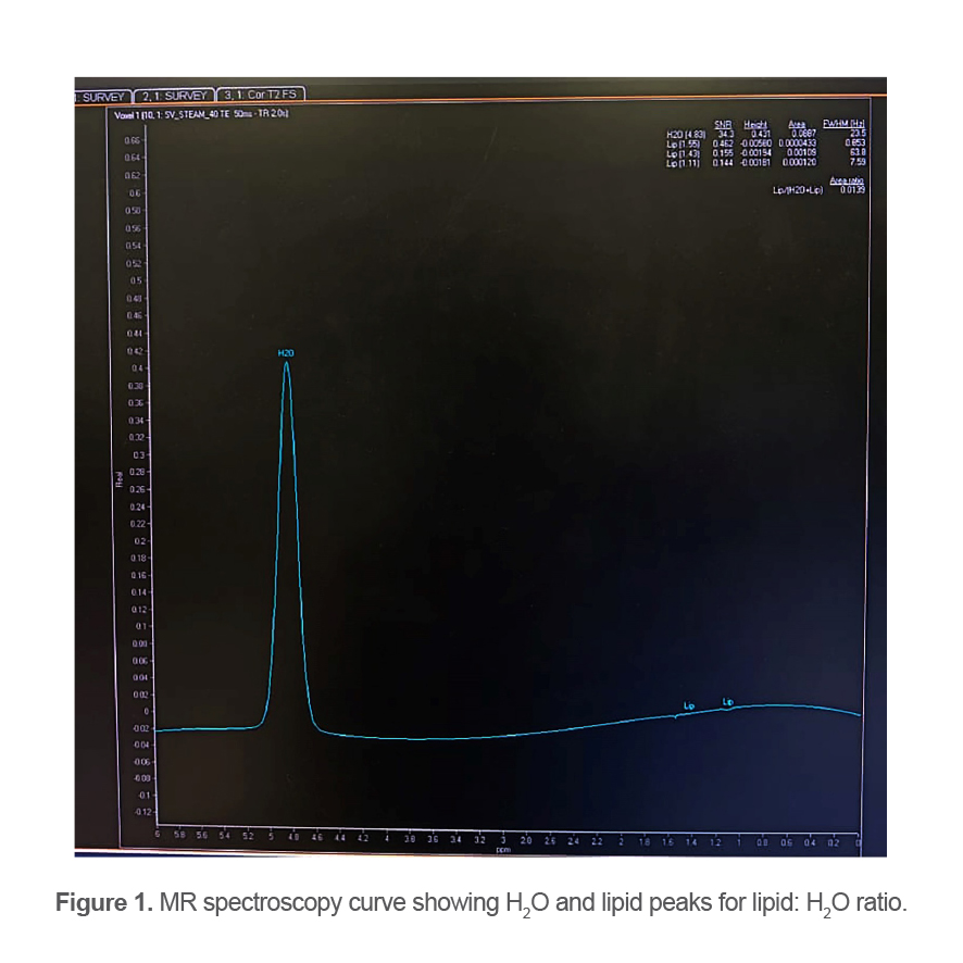 Figure 1. MR spectroscopy curve showing H2O and lipid peaks for lipid: H2O ratio.