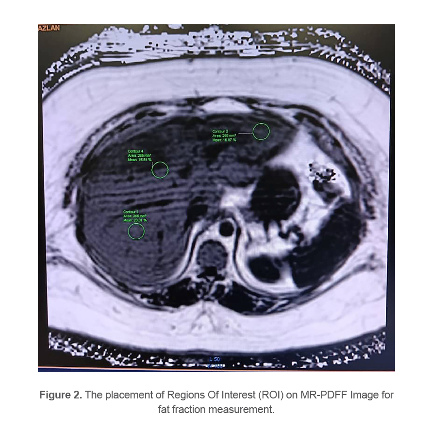Figure 2. The placement of Regions Of Interest (ROI) on MR-PDFF Image for fat fraction measurement.