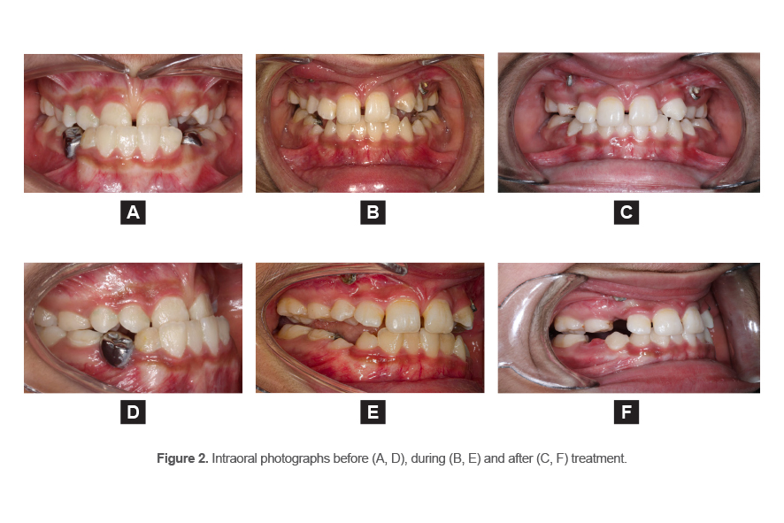 Figure 2. Intraoral photographs before (A, D), during (B, E) and after (C, F) treatment.