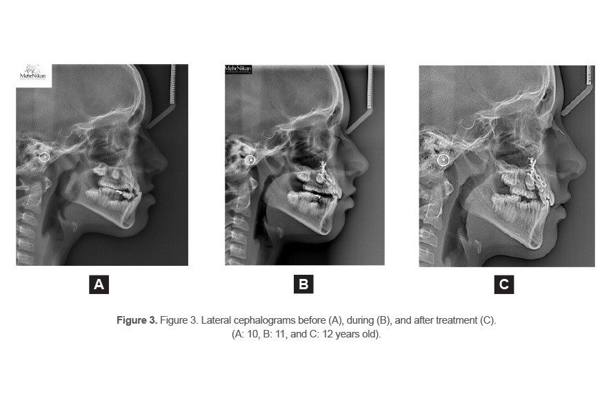 Figure 3. Figure 3. Lateral cephalograms before (A), during (B), and after treatment (C).  (A: 10, B: 11, and C: 12 years old).