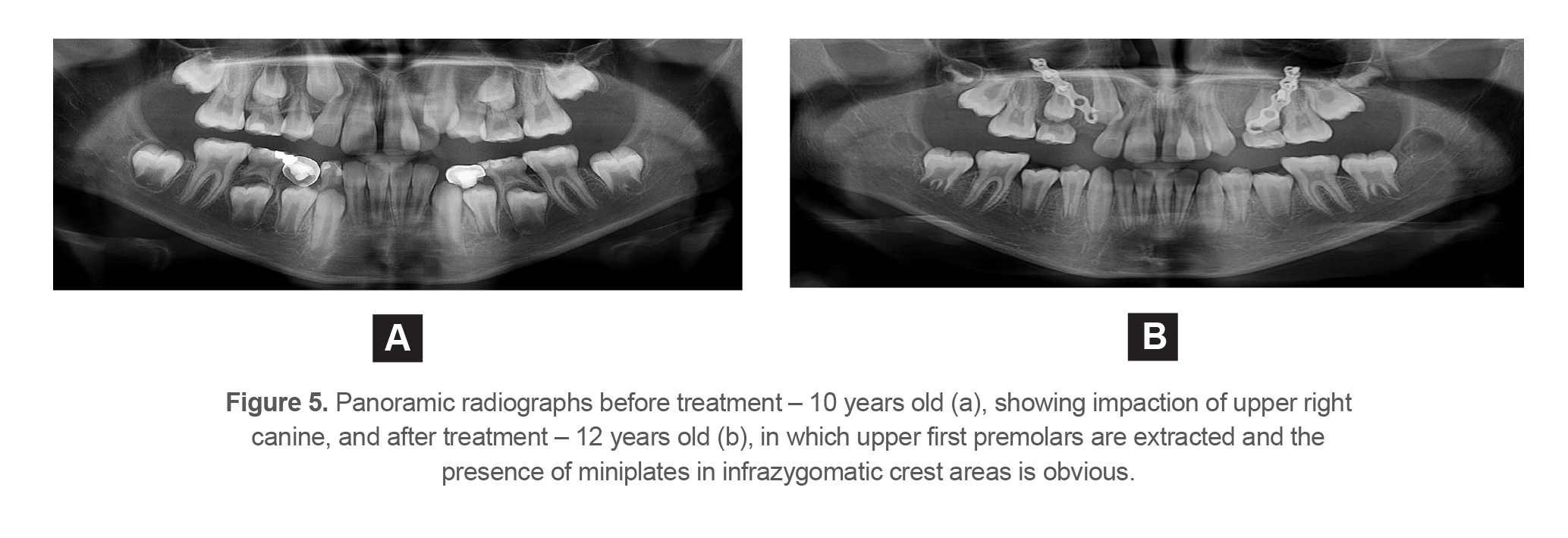 Figure 5. Panoramic radiographs before treatment – 10 years old (a), showing impaction of upper right canine, and after treatment – 12 years old (b), in which upper first premolars are extracted and the presence of miniplates in infrazygomatic crest areas is obvious.