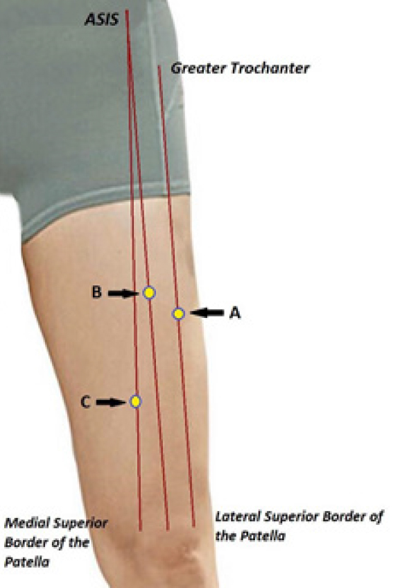 Figure 1. Locations dry needled for quadriceps recovery after fatiguing activity. A: vastus lateralis; B: rectus femoris; C: vastus medialis. ASIS, anterior superior iliac spine.