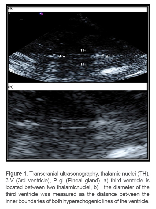 Figure 1. Transcranial ultrasonography, thalamic nuclei (TH), 3.V (3rd ventricle), P gl (Pineal gland). a) third ventricle is located between two thalamicnuclei, b)   the diameter of the third ventricle was measured as the distance between the inner boundaries of both hyperechogenic lines of the ventricle.