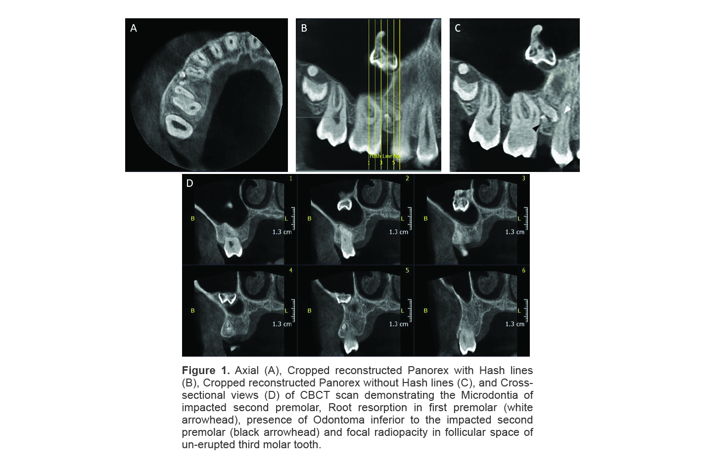 Figure 1. Axial (A), Cropped reconstructed Panorex with Hash lines (B), Cropped reconstructed Panorex without Hash lines (C), and Cross-sectional views (D) of CBCT scan demonstrating the Microdontia of impacted second premolar, Root resorption in first premolar (white arrowhead), presence of Odontoma inferior to the impacted second premolar (black arrowhead) and focal radiopacity in follicular space of un-erupted third molar tooth.