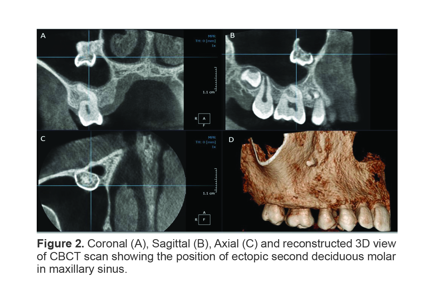 Figure 2. Coronal (A), Sagittal (B), Axial (C) and reconstructed 3D view of CBCT scan showing the position of ectopic second deciduous molar in maxillary sinus.