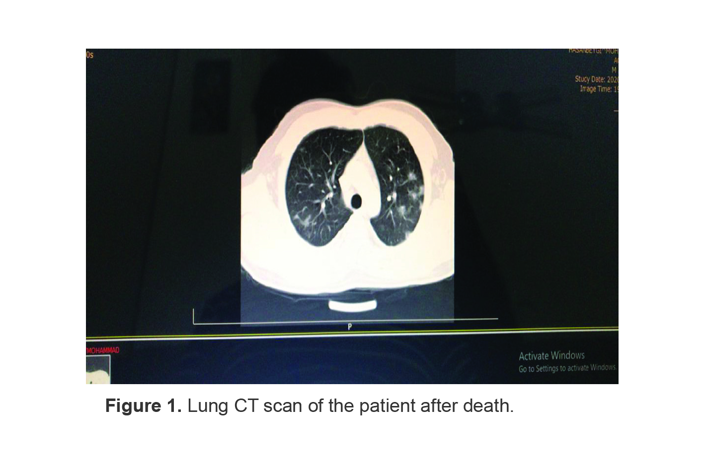 Figure 1. Lung CT scan of the patient after death.