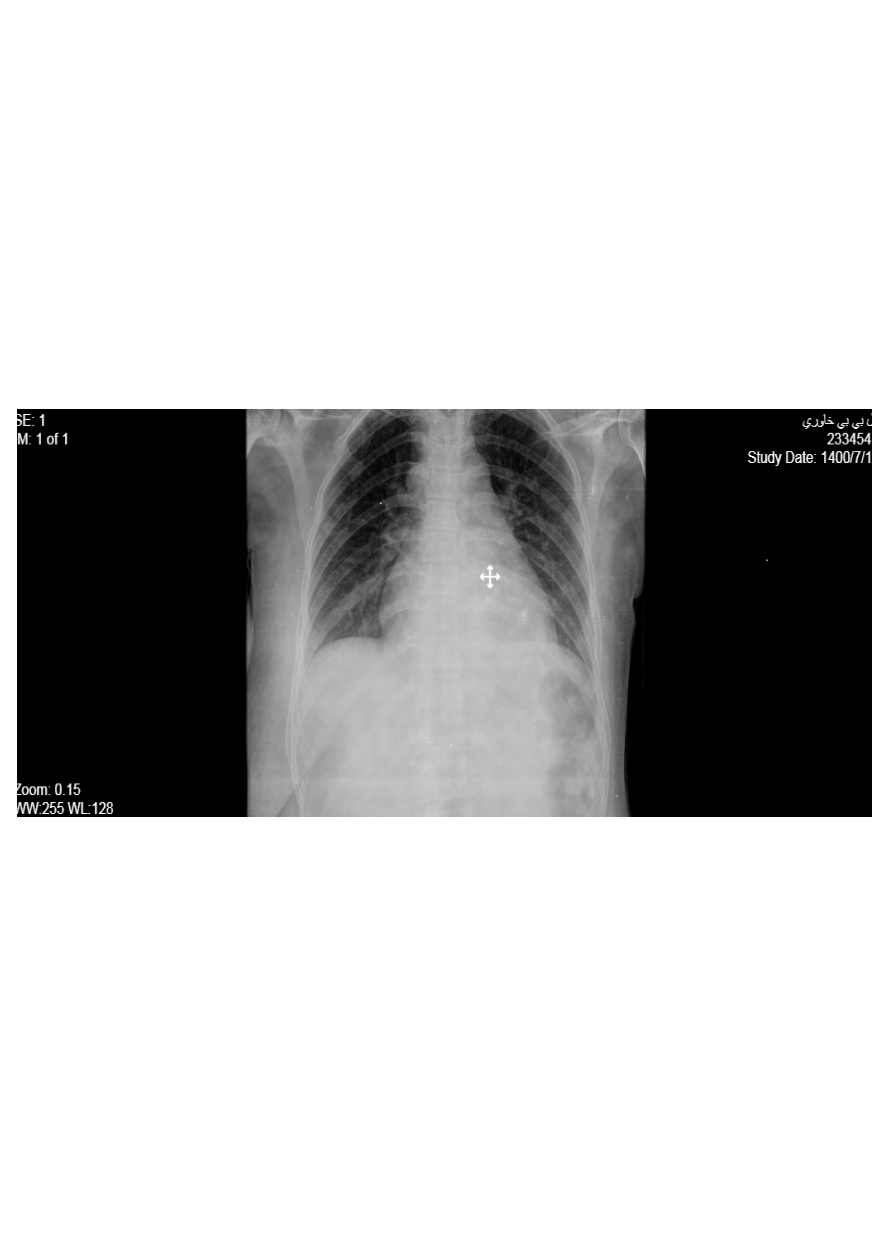 Figure 4. Chest x-ray after mastectomy without arenchymal and rib involvement.