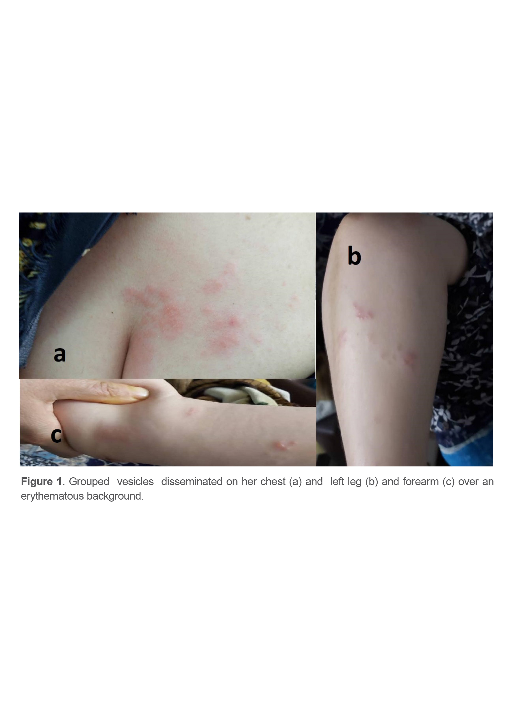 Figure 1. Grouped  vesicles  disseminated on her chest (a) and  left leg (b) and forearm (c) over an erythematous background.