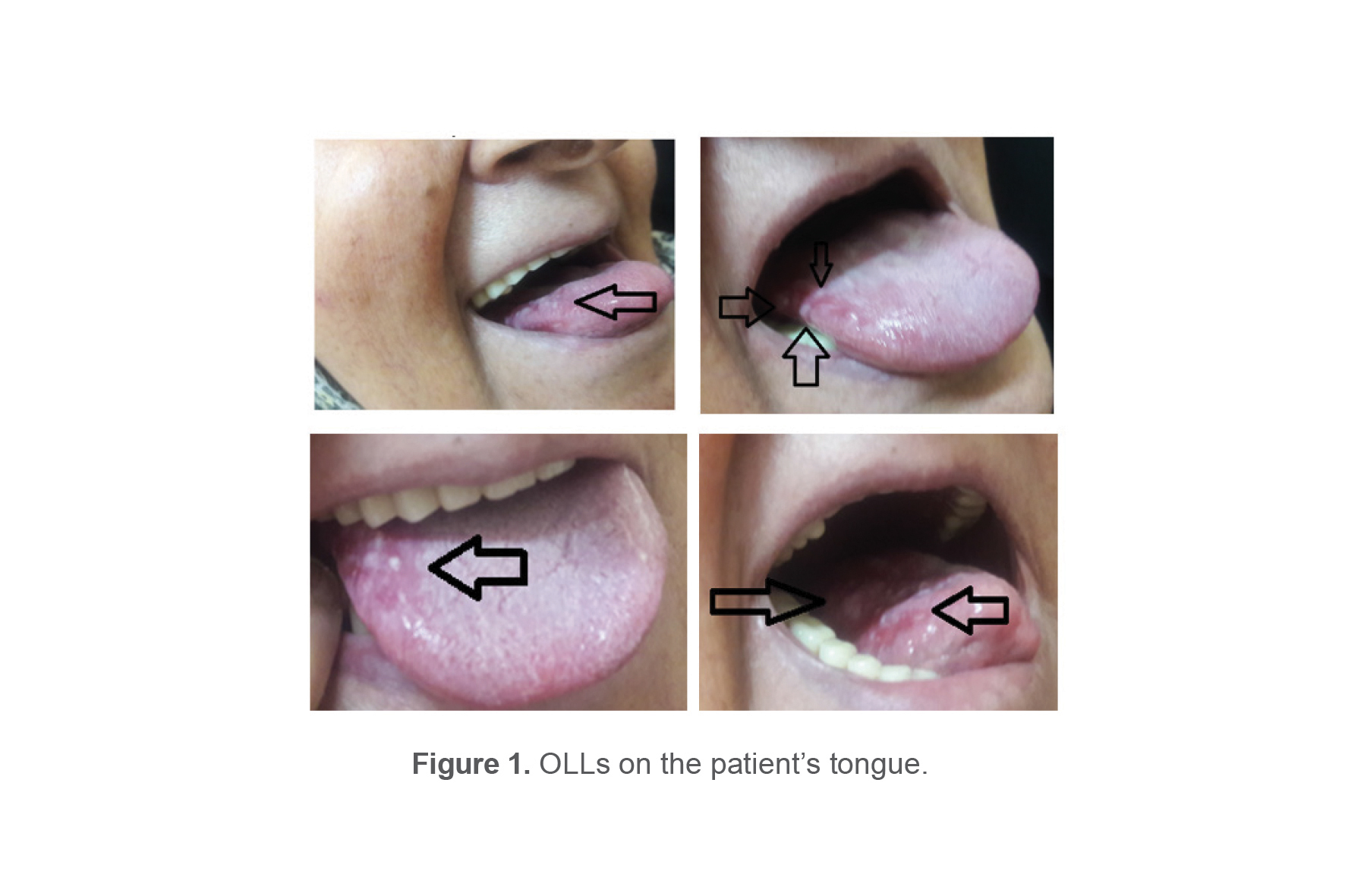 Figure 1. OLLs on the patient&rsquo;s tongue.