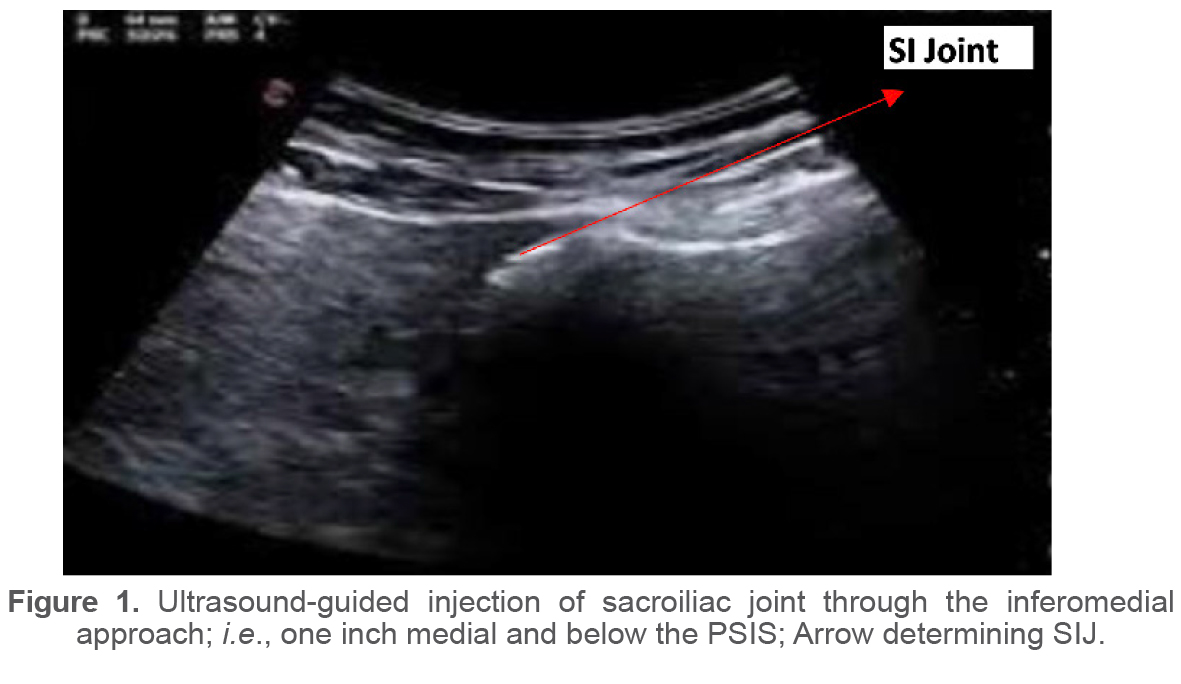 Figure 1. Ultrasound-guided injection of sacroiliac joint through the inferomedial approach; i.e., one inch medial and below the PSIS; Arrow determining SIJ.