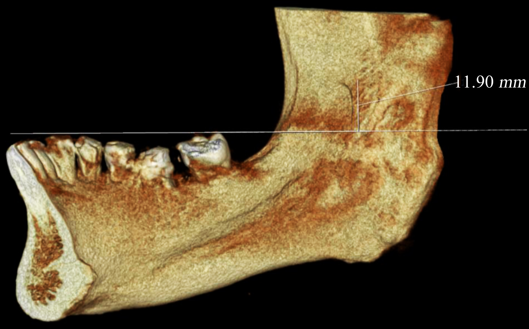 Figure 2. Distance between the occlusal plane and mandibular foramen measured on CBCT scans in NNT Viewer software.