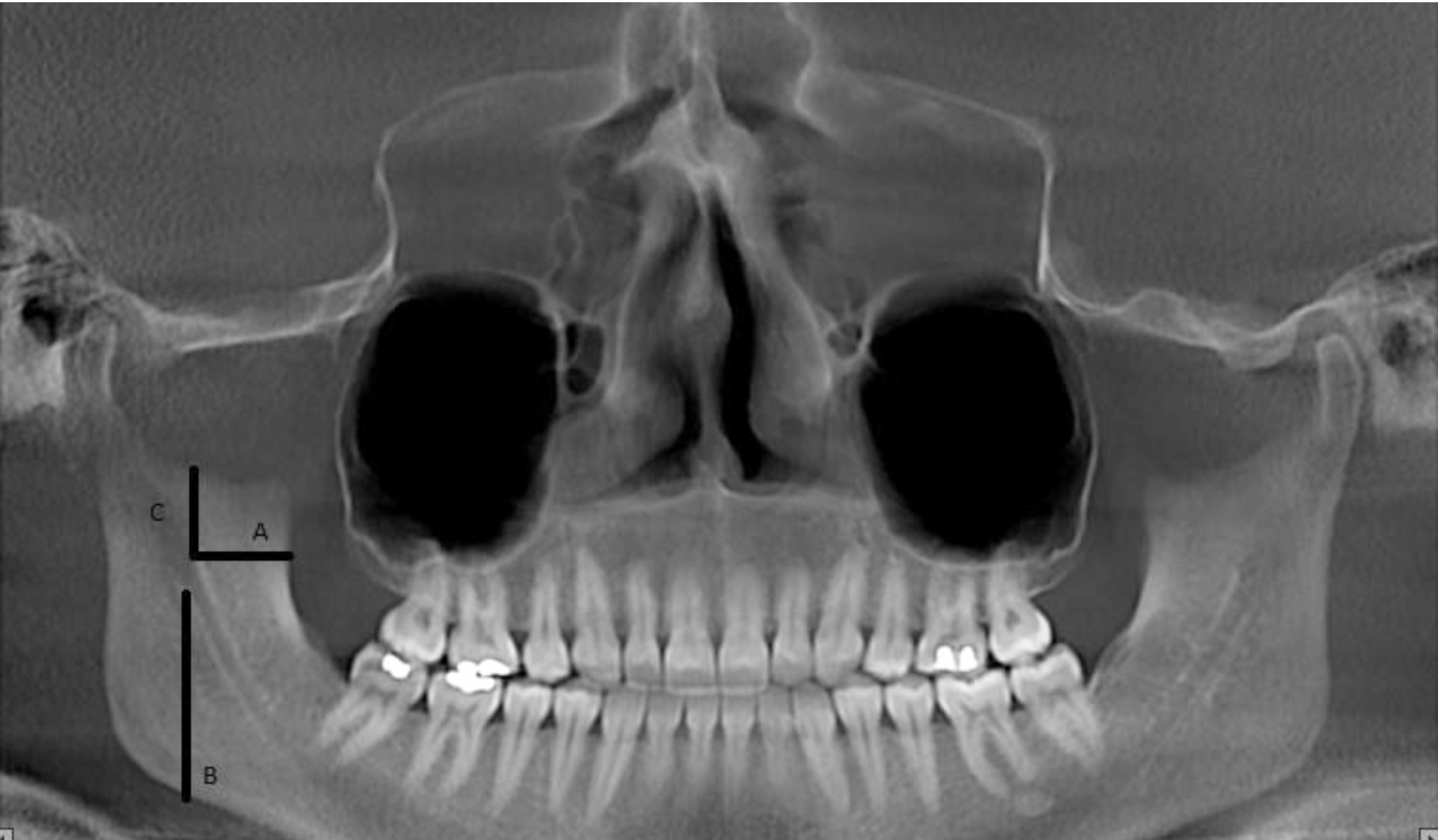 Figure 1. Measurement of A, B and C distances on CBCT scans to determine the position of mandibular foramen.