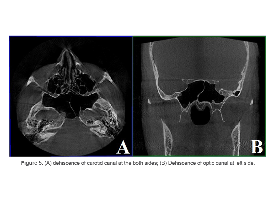 Figure 5. (A) dehiscence of carotid canal at the both sides; (B) Dehiscence of optic canal at left side.
