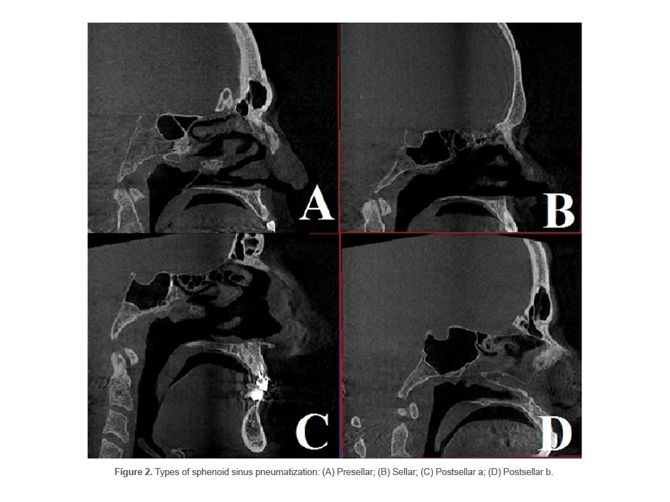 Figure 2. Types of sphenoid sinus pneumatization: (A) Presellar; (B) Sellar; (C) Postsellar a; (D) Postsellar b.
