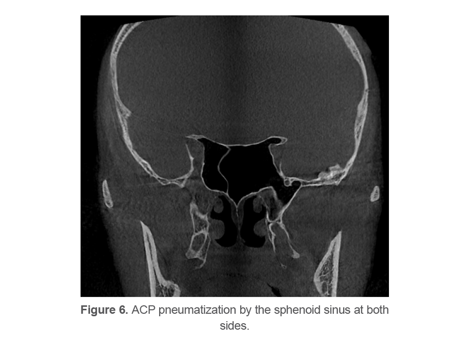 Figure 6. ACP pneumatization by the sphenoid sinus at both sides.