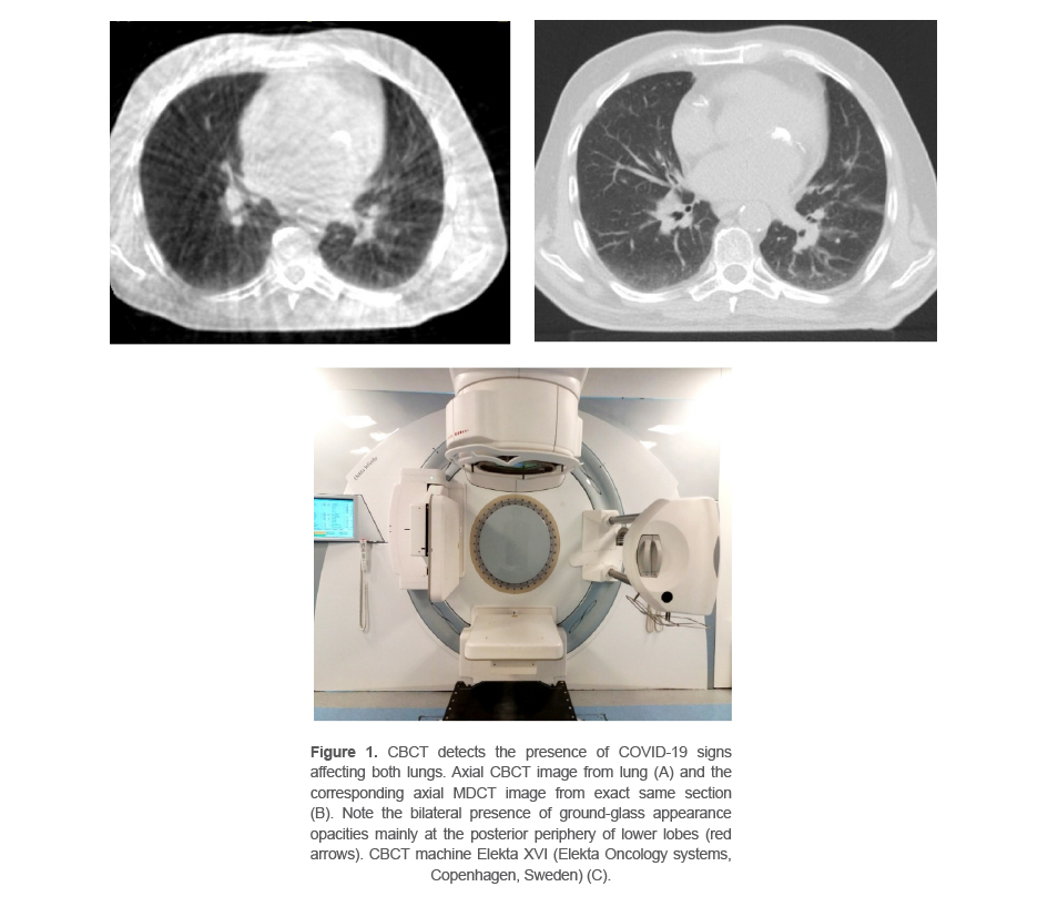Figure 1. CBCT detects the presence of COVID-19 signs affecting both lungs. Axial CBCT image from lung (A) and the corresponding axial MDCT image from exact same section (B). Note the bilateral presence of ground-glass appearance opacities mainly at the posterior periphery of lower lobes (red arrows). CBCT machine Elekta XVI (Elekta Oncology systems, Copenhagen, Sweden) (C).