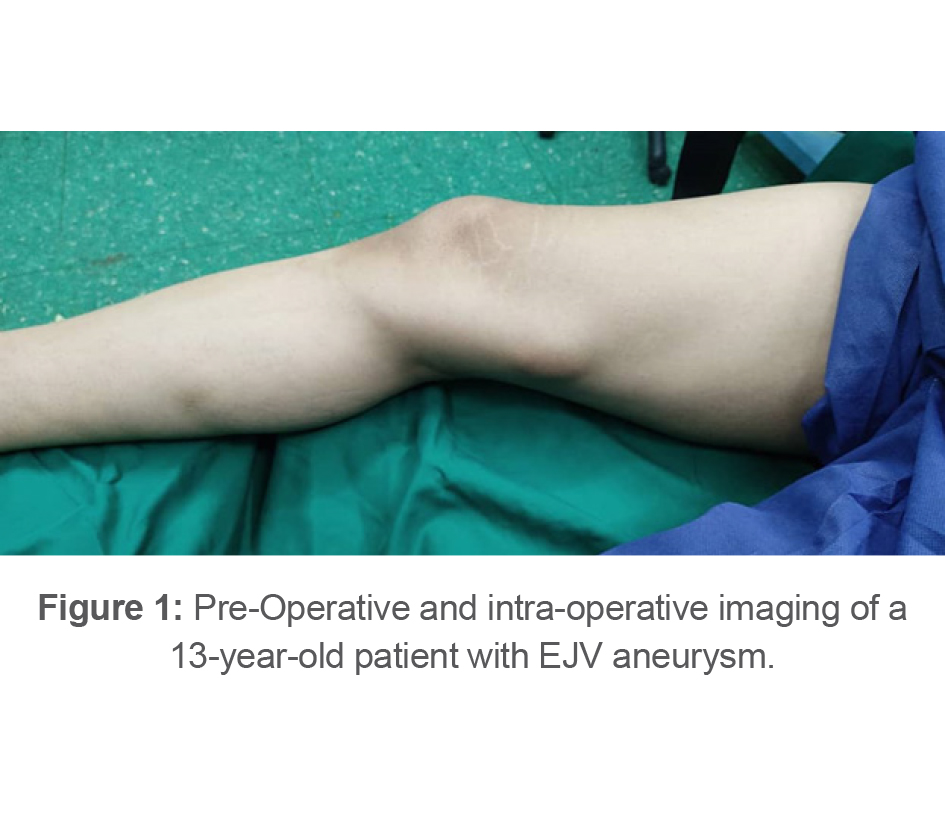 Figure 1: Pre-Operative and intra-operative imaging of a 13-year-old patient with EJV aneurysm.