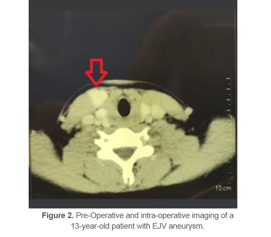 Figure 2. Pre-Operative and intra-operative imaging of a 13-year-old patient with EJV aneurysm.