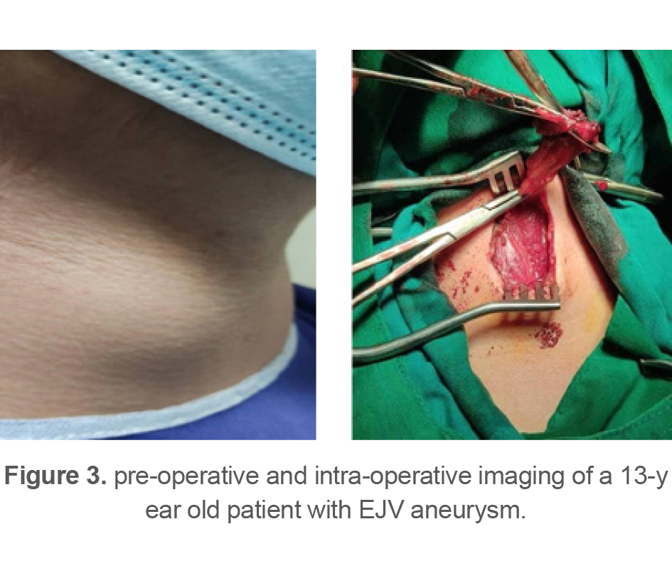 Figure 3. pre-operative and intra-operative imaging of a 13-y ear old patient with EJV aneurysm.