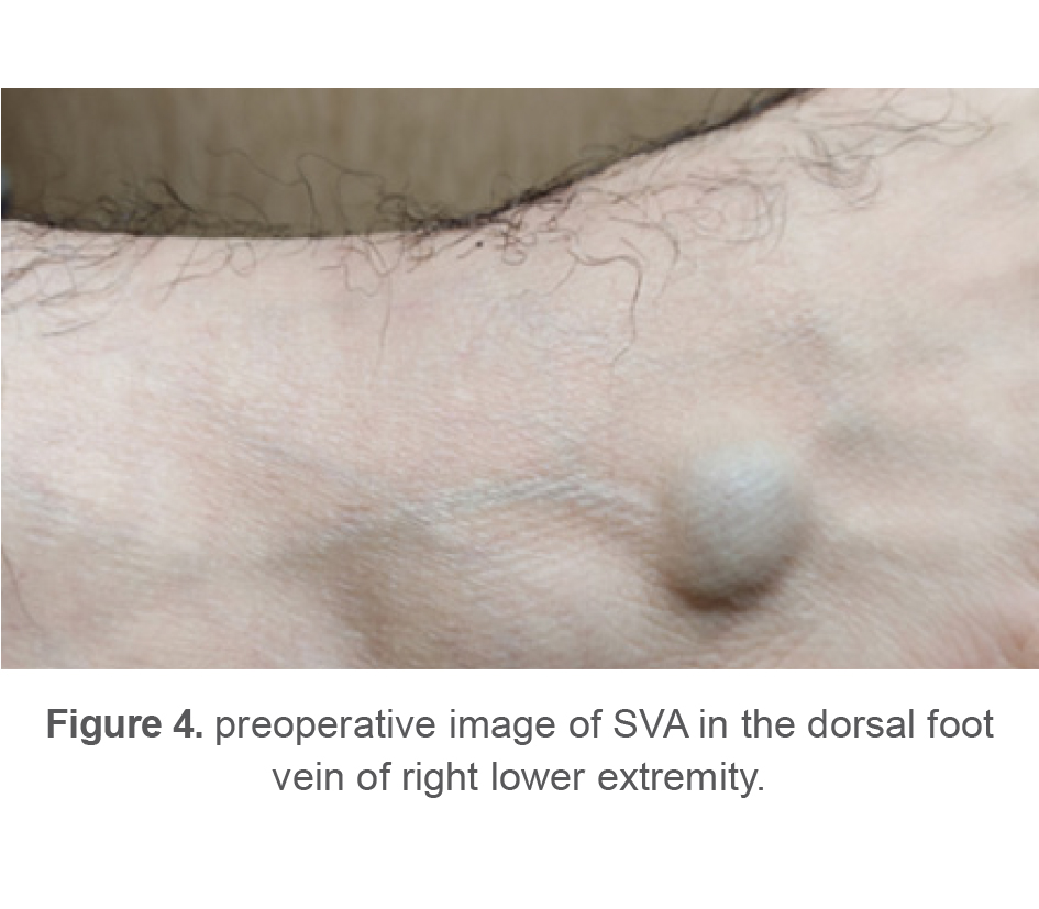 Figure 4. preoperative image of SVA in the dorsal foot  vein of right lower extremity.