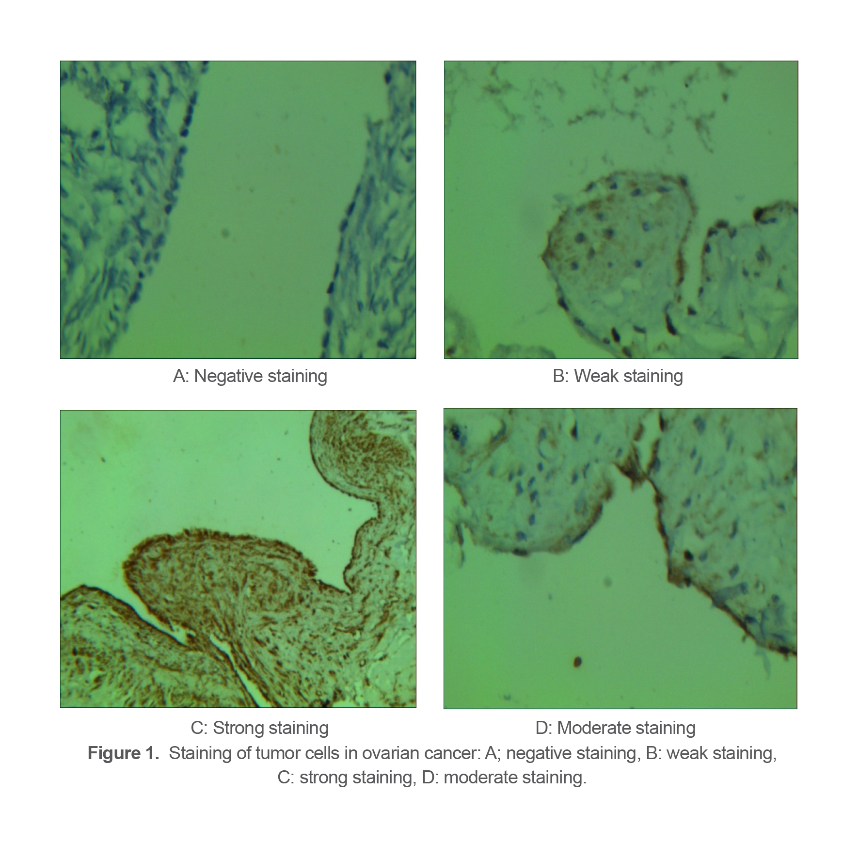 Figure 1.  Staining of tumor cells in ovarian cancer: A; negative staining, B: weak staining, C: strong staining, D: moderate staining.