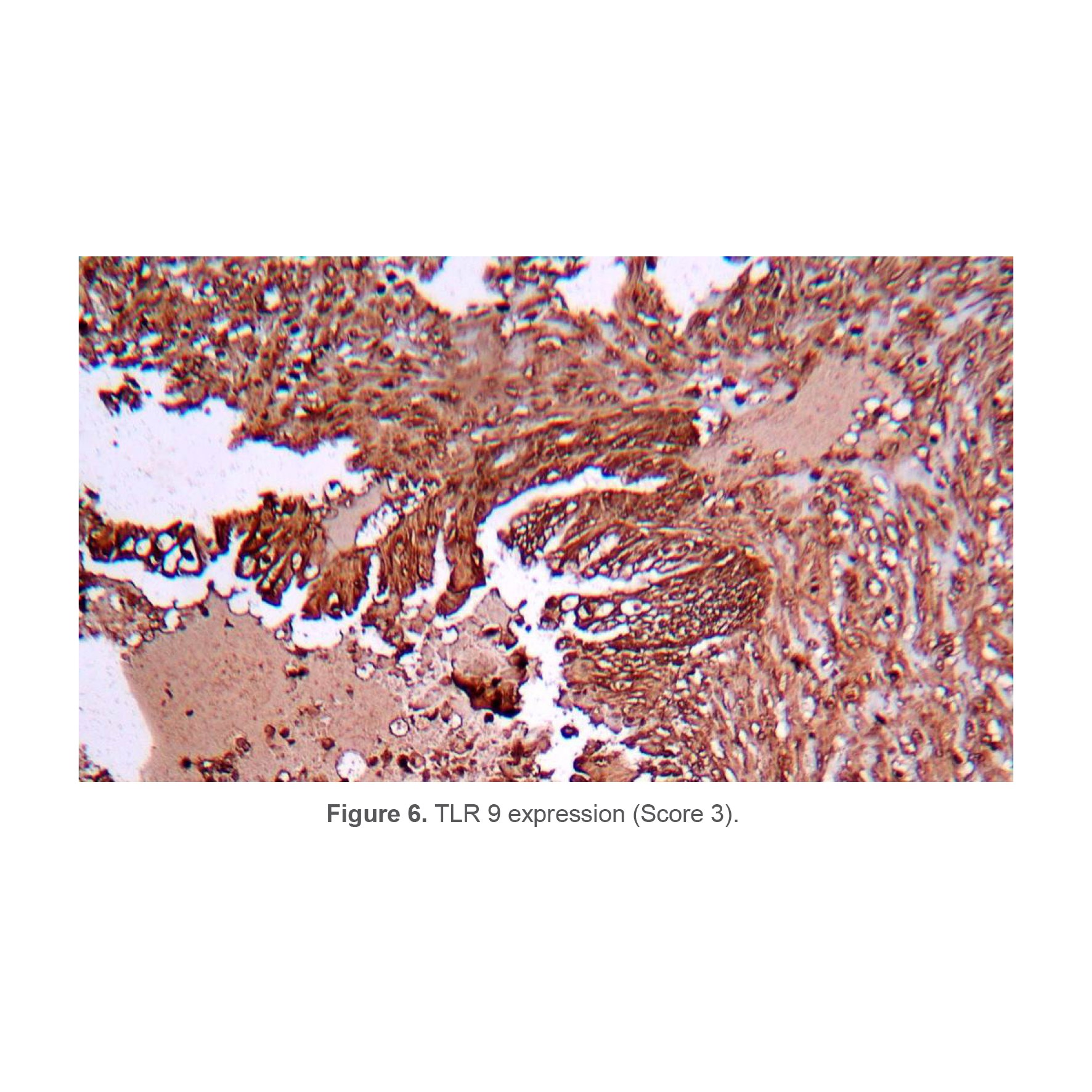 Figure 6. TLR 9 expression (Score 3).