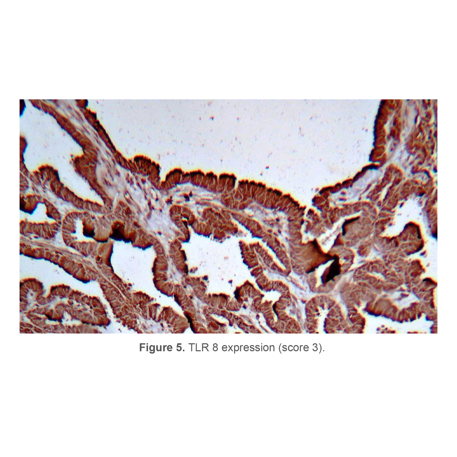 Figure 5. TLR 8 expression (score 3).