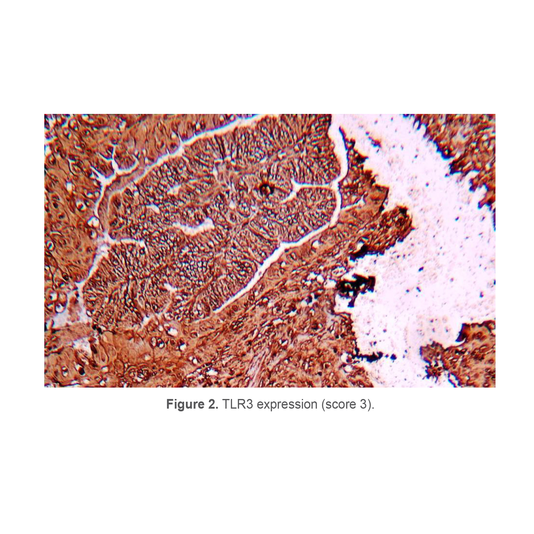 Figure 2. TLR3 expression (score 3).