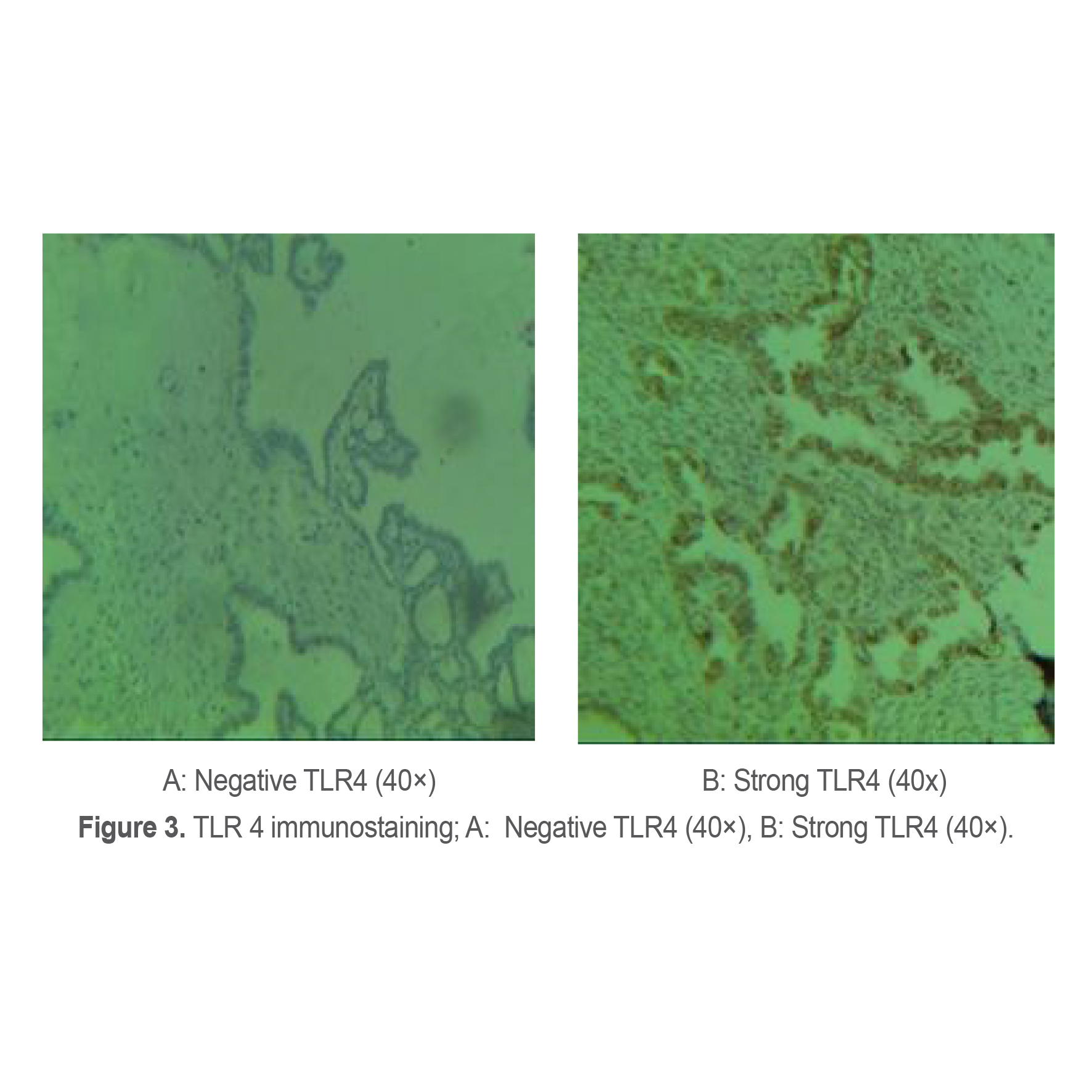 Figure 3. TLR 4 immunostaining; A:  Negative TLR4 (40&times;), B: Strong TLR4 (40&times;).