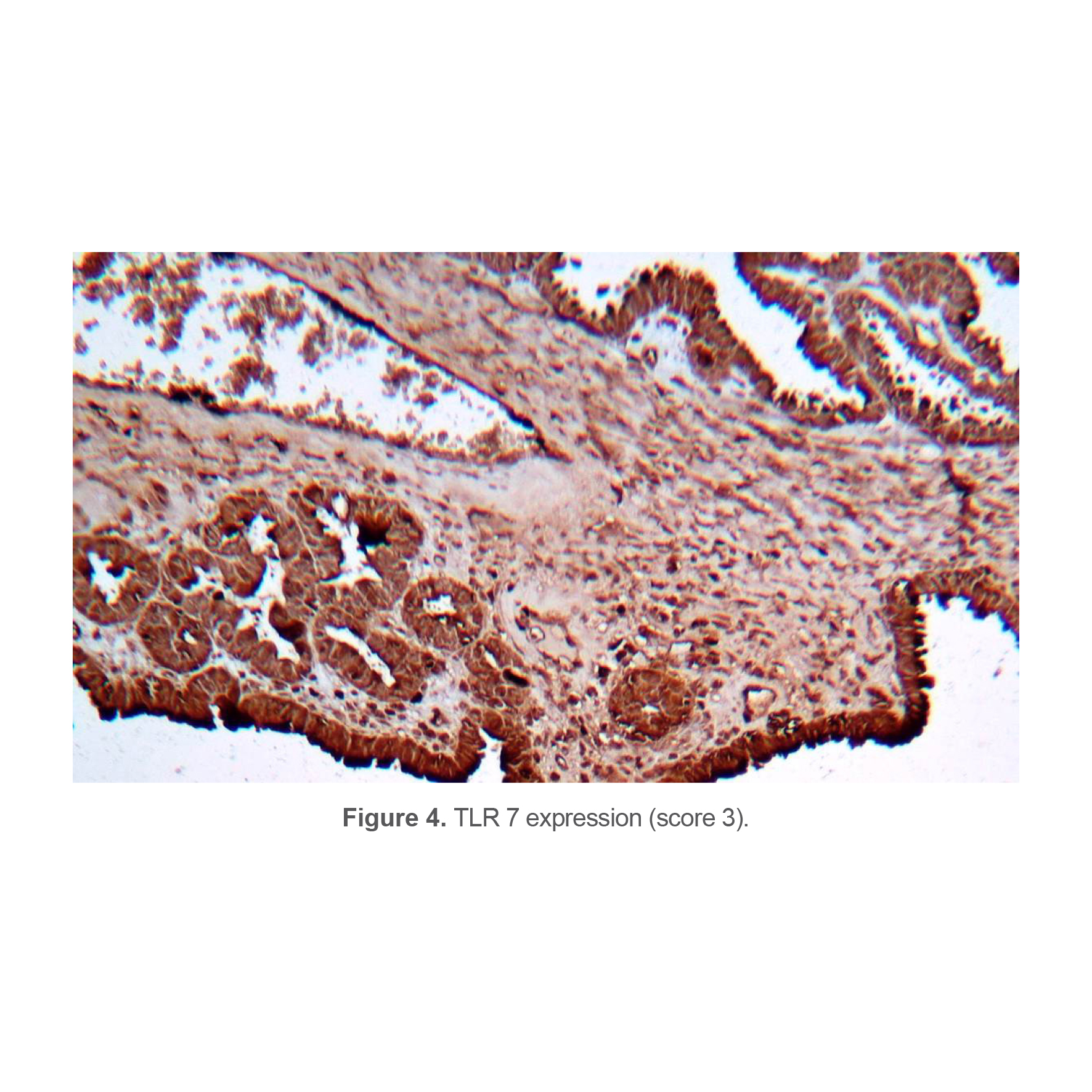 Figure 4. TLR 7 expression (score 3).