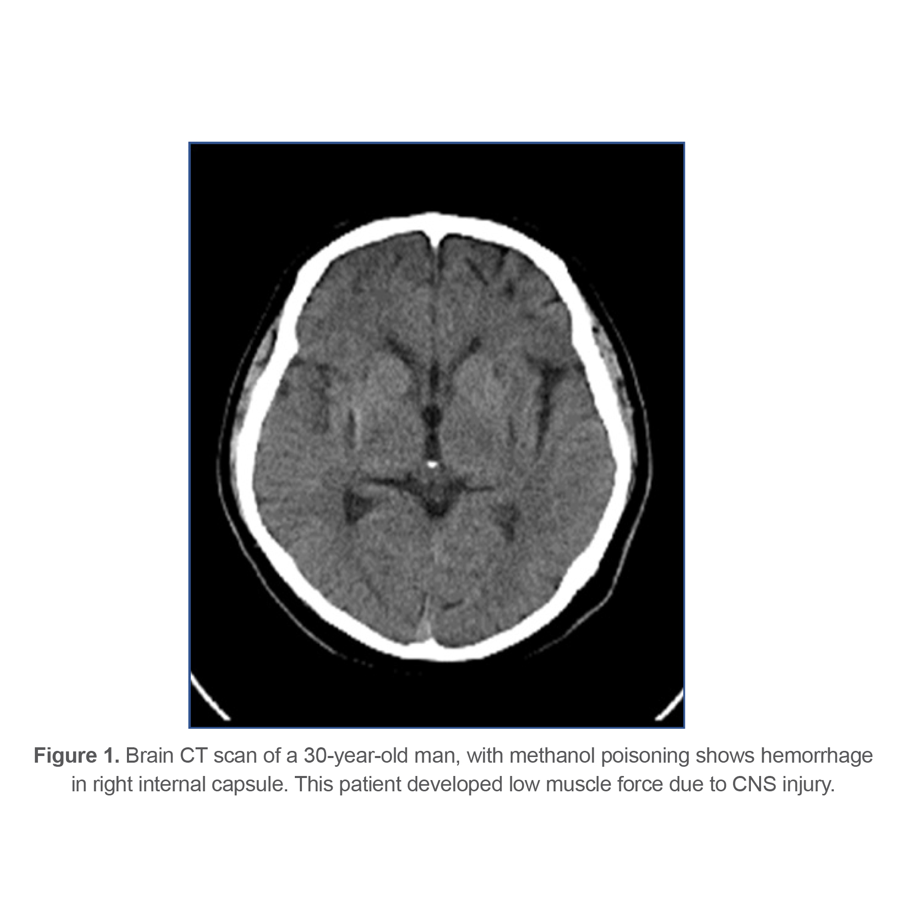 Brain CT scan of a 30-year-old man, with methanol poisoning shows hemorrhage in right internal capsule. This patient developed low muscle force due to CNS injury.