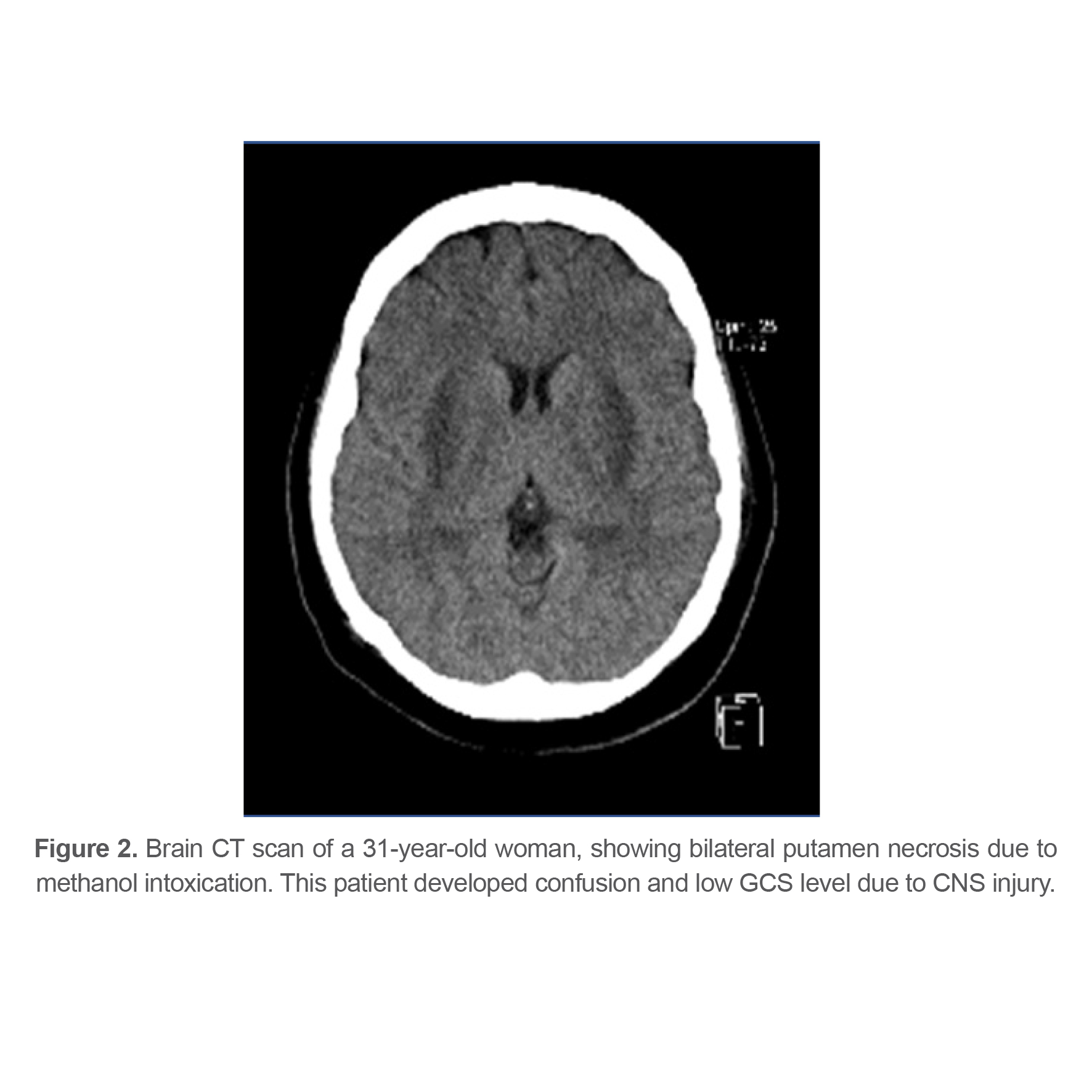 Figure 2. Brain CT scan of a 31-year-old woman, showing bilateral putamen necrosis due to methanol intoxication. This patient developed confusion and low GCS level due to CNS injury.