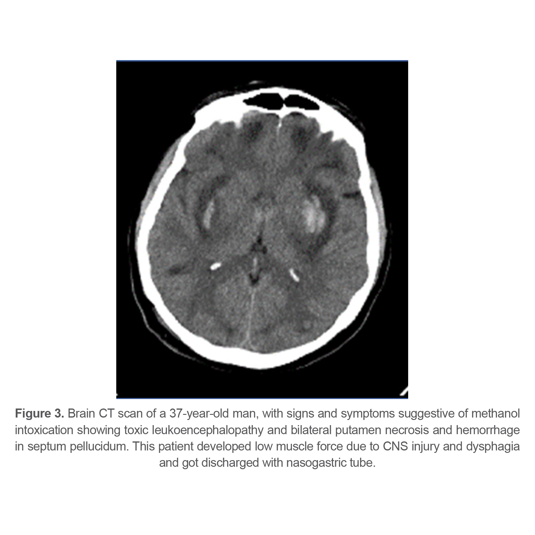 Figure 3. Brain CT scan of a 37-year-old man, with signs and symptoms suggestive of methanol intoxication showing toxic leukoencephalopathy and bilateral putamen necrosis and hemorrhage in septum pellucidum. This patient developed low muscle force due to CNS injury and dysphagia and got discharged with nasogastric tube.