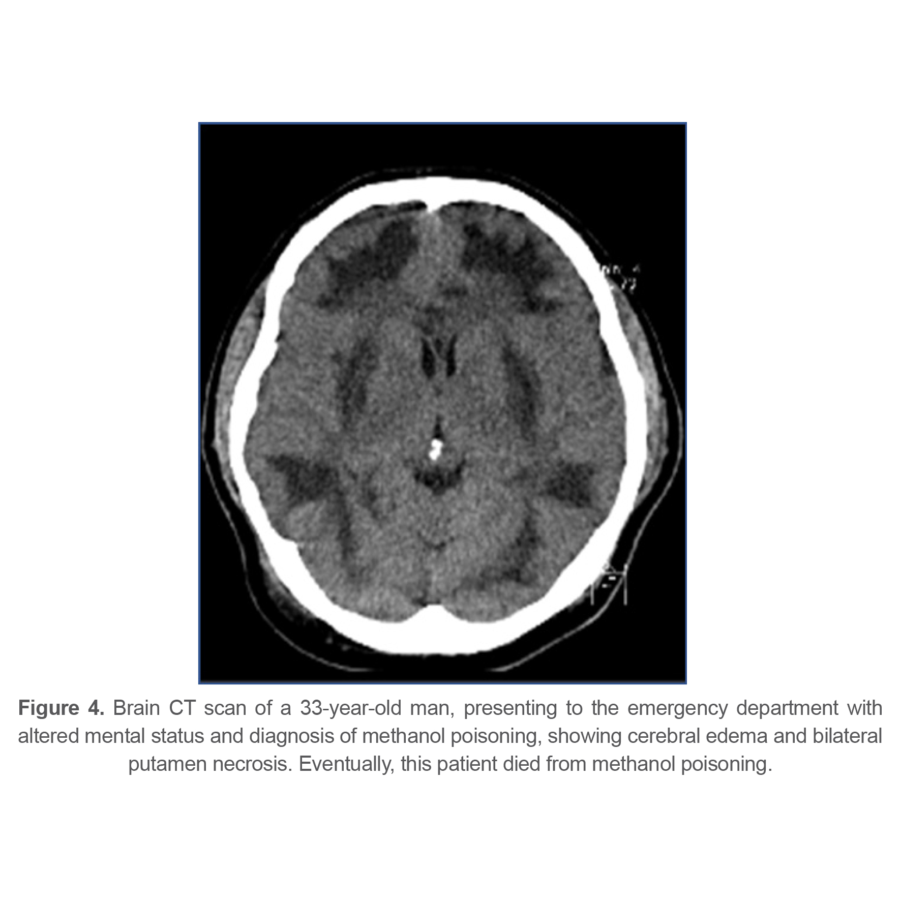 Figure 4. Brain CT scan of a 33-year-old man, presenting to the emergency department with altered mental status and diagnosis of methanol poisoning, showing cerebral edema and bilateral putamen necrosis. Eventually, this patient died from methanol poisoning.