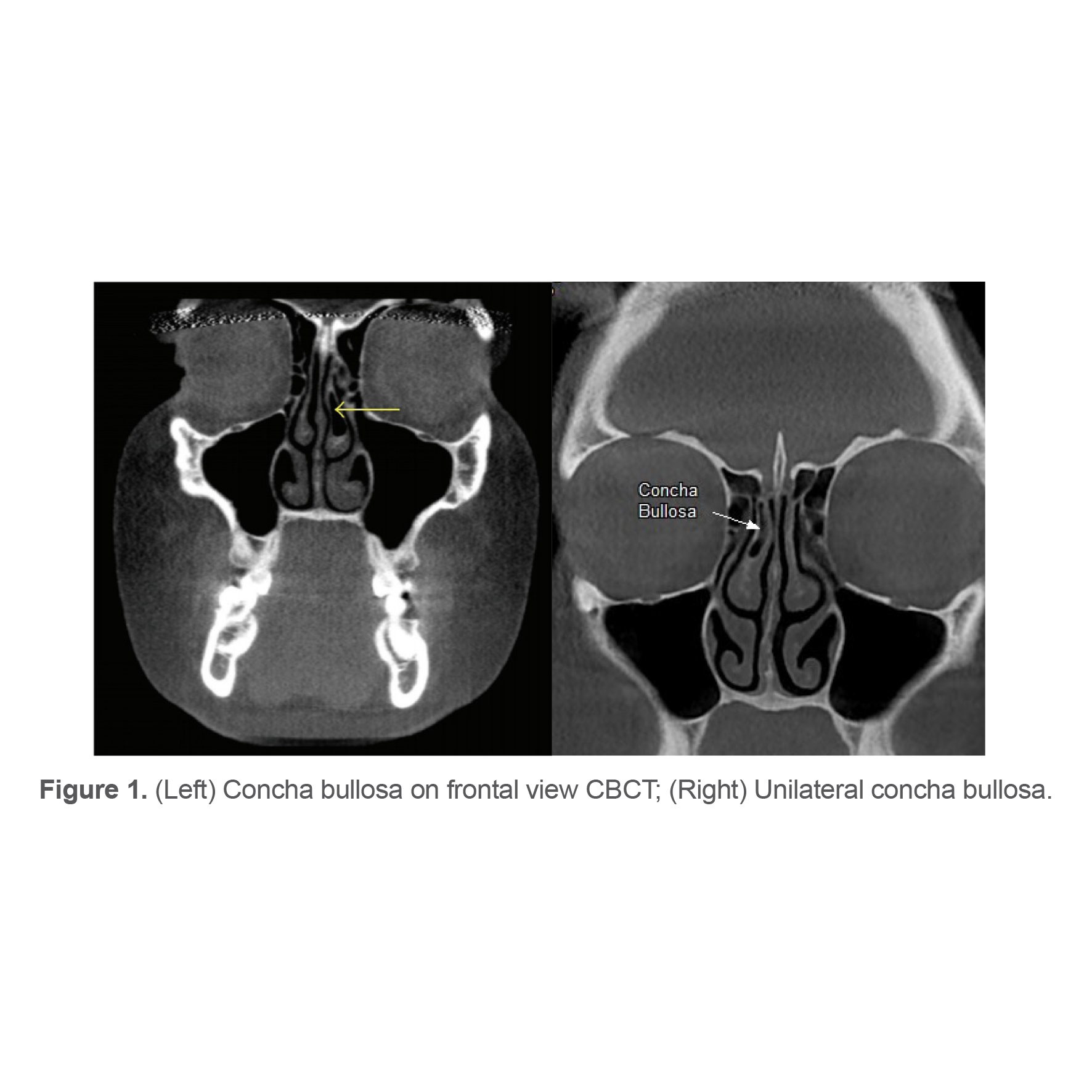 Figure 1. (Left) Concha bullosa on frontal view CBCT; (Right) Unilateral concha bullosa.