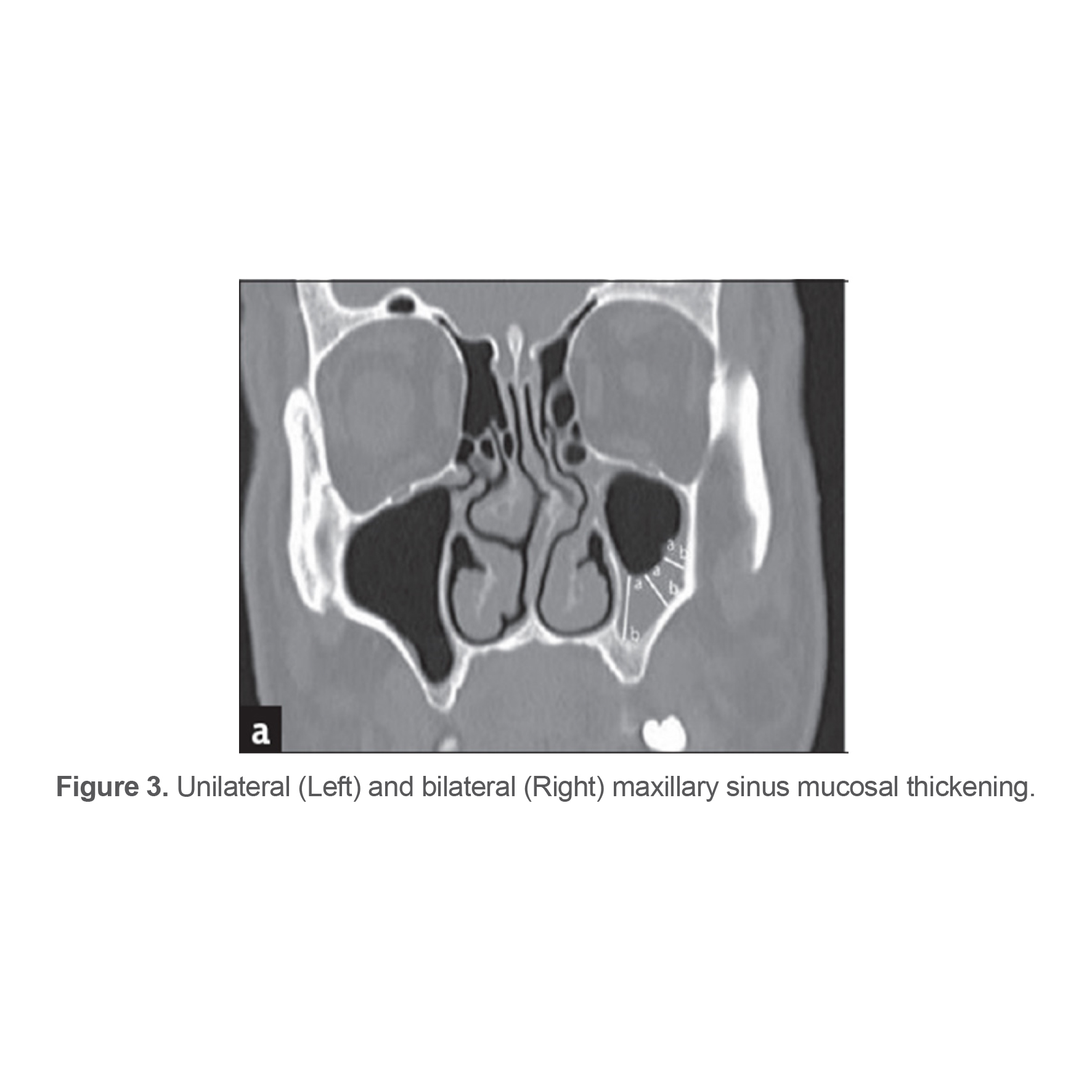 Figure 3. Unilateral (Left) and bilateral (Right) maxillary sinus mucosal thickening.