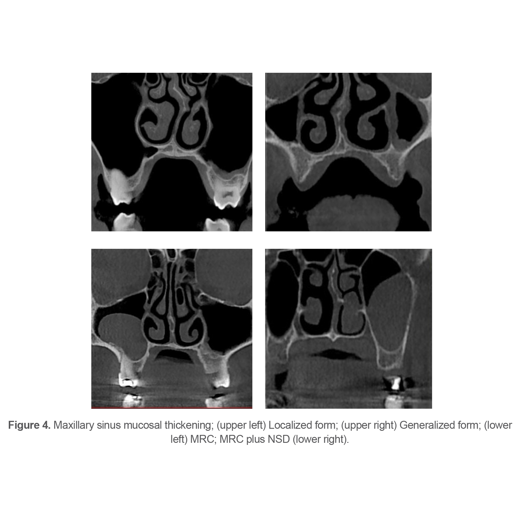 Figure 4. Maxillary sinus mucosal thickening; (upper left) Localized form; (upper right) Generalized form; (lower left) MRC; MRC plus NSD (lower right).