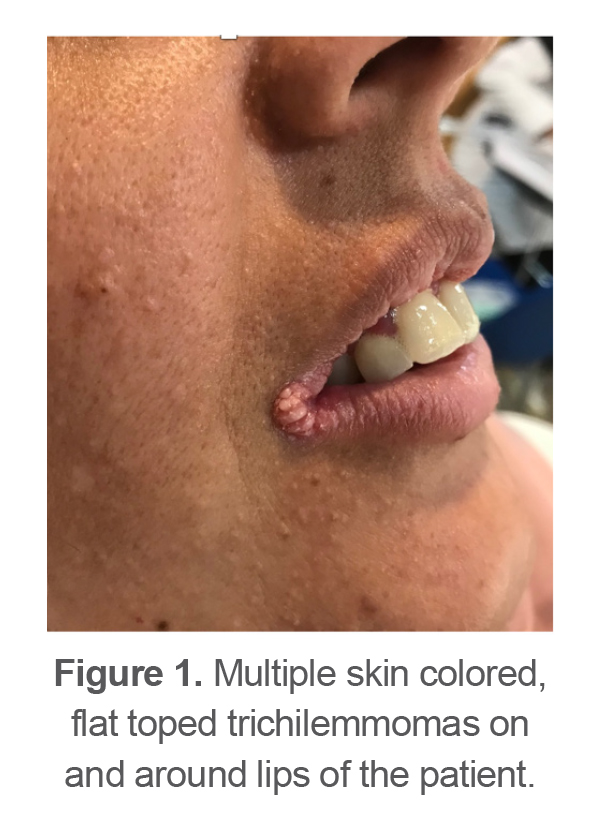 Figure 1. Multiple skin colored, flat toped trichilemmomas on and around lips of the patient.