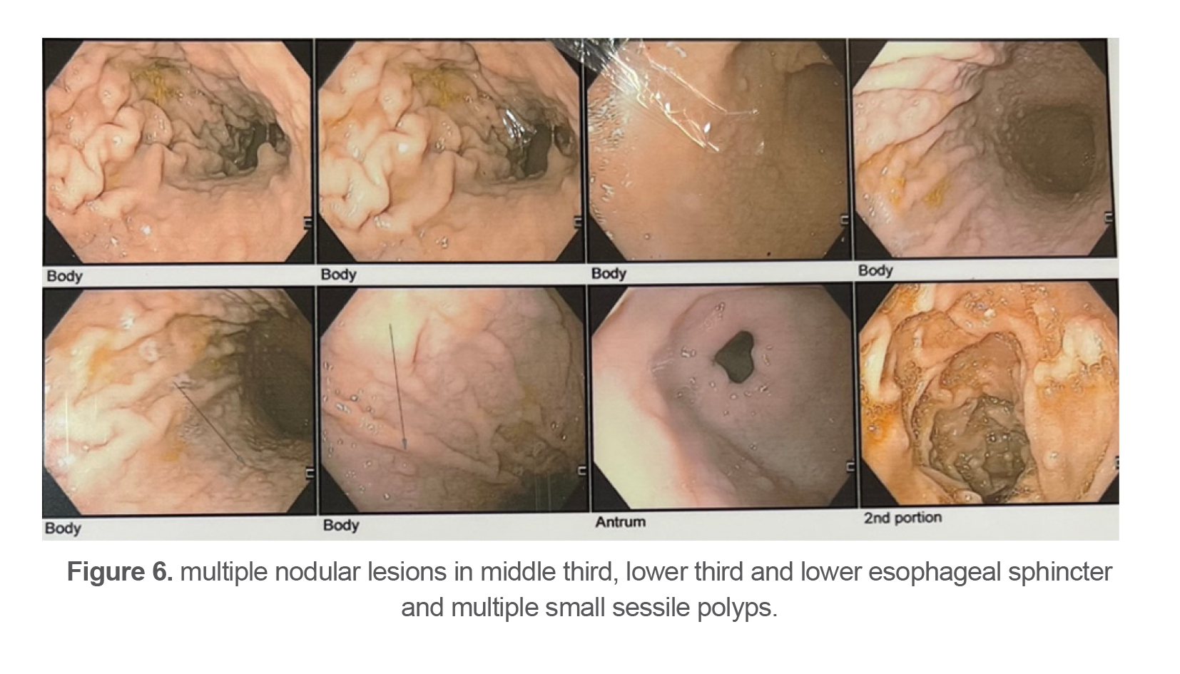 Figure 6. multiple nodular lesions in middle third, lower third and lower esophageal sphincter                 and multiple small sessile polyps.