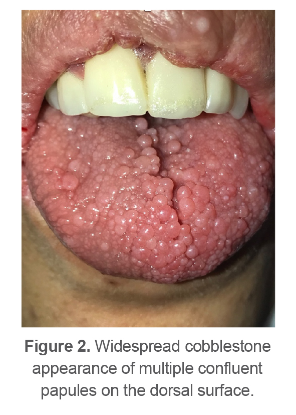 Figure 2. Widespread cobblestone appearance of multiple confluent papules on the dorsal surface.