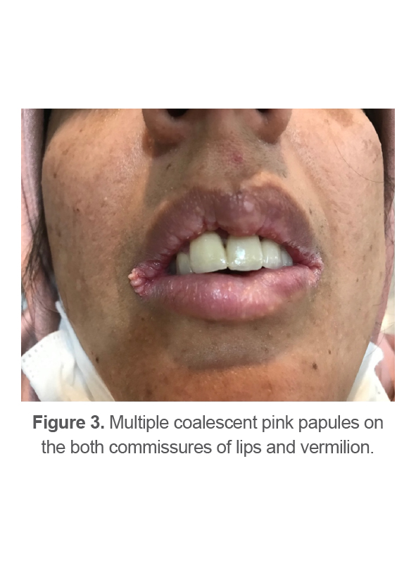 Figure 3. Multiple coalescent pink papules on the both commissures of lips and vermilion.