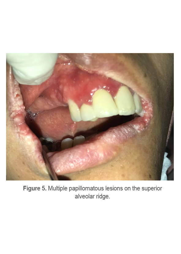 Figure 5. Multiple papillomatous lesions on the superior alveolar ridge.
