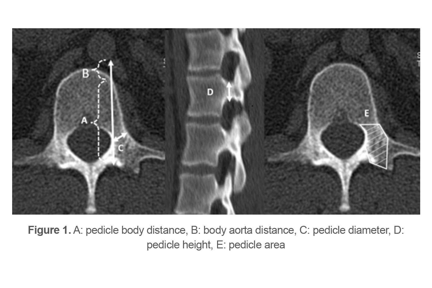 Figure 1. A: pedicle body distance, B: body aorta distance, C: pedicle diameter, D: pedicle height, E: pedicle area