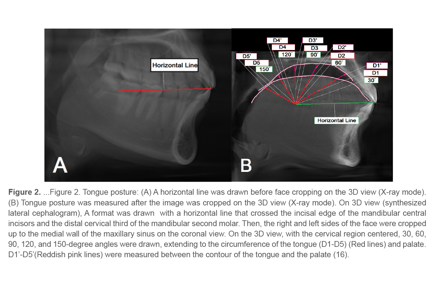 Figure 2. ...Figure 2. Tongue posture: (A) A horizontal line was drawn before face cropping on the 3D view (X-ray mode). (B) Tongue posture was measured after the image was cropped on the 3D view (X-ray mode). On 3D view (synthesized lateral cephalogram), A format was drawn  with a horizontal line that crossed the incisal edge of the mandibular central incisors and the distal cervical third of the mandibular second molar. Then, the right and left sides of the face were cropped up to the medial wall of the maxillary sinus on the coronal view. On the 3D view, with the cervical region centered, 30, 60, 90, 120, and 150-degree angles were drawn, extending to the circumference of the tongue (D1-D5) (Red lines) and palate. D1’-D5’(Reddish pink lines) were measured between the contour of the tongue and the palate (16).