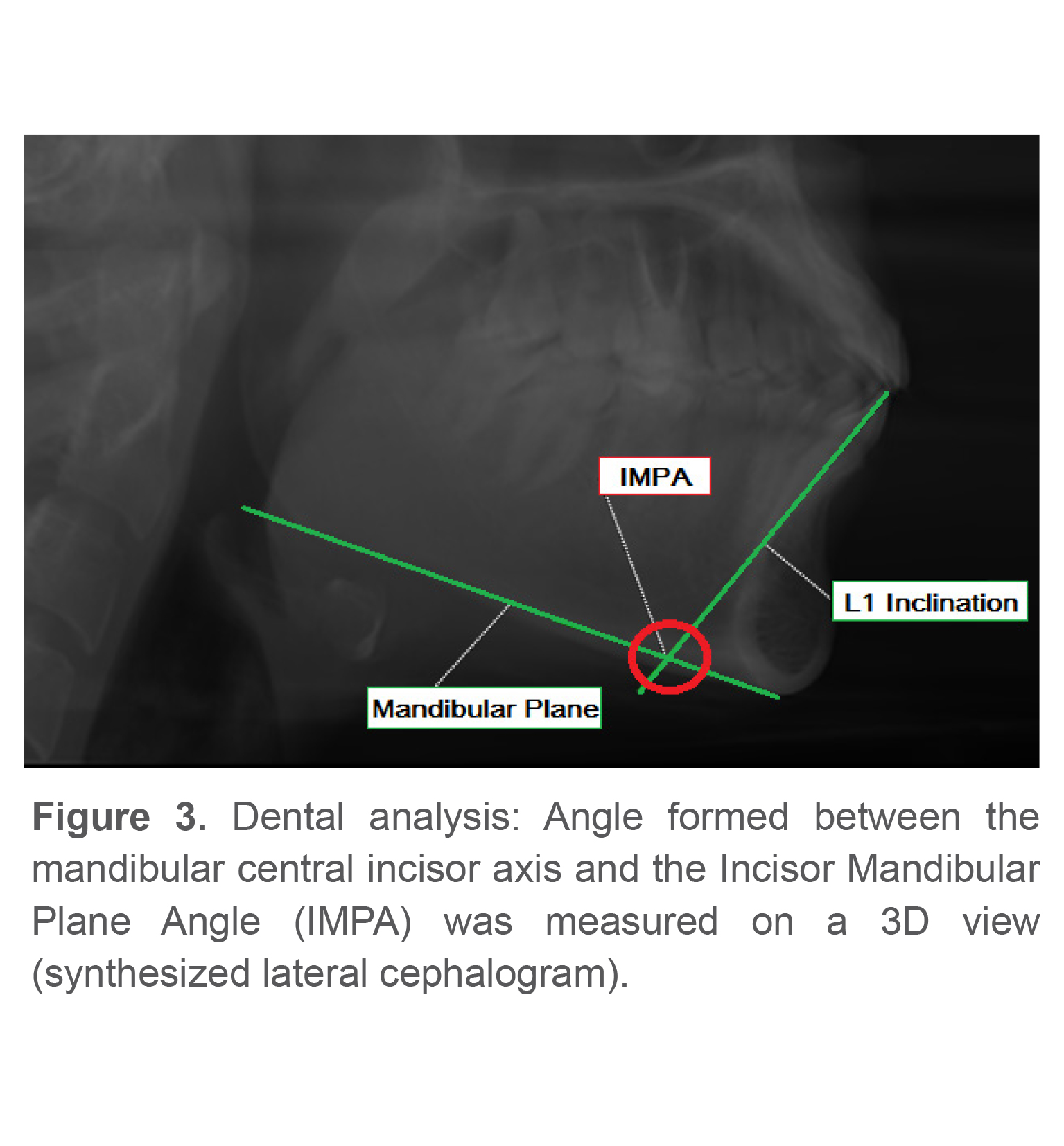 Figure 3. Dental analysis: Angle formed between the mandibular central incisor axis and the Incisor Mandibular Plane Angle (IMPA) was measured on a 3D view (synthesized lateral cephalogram).