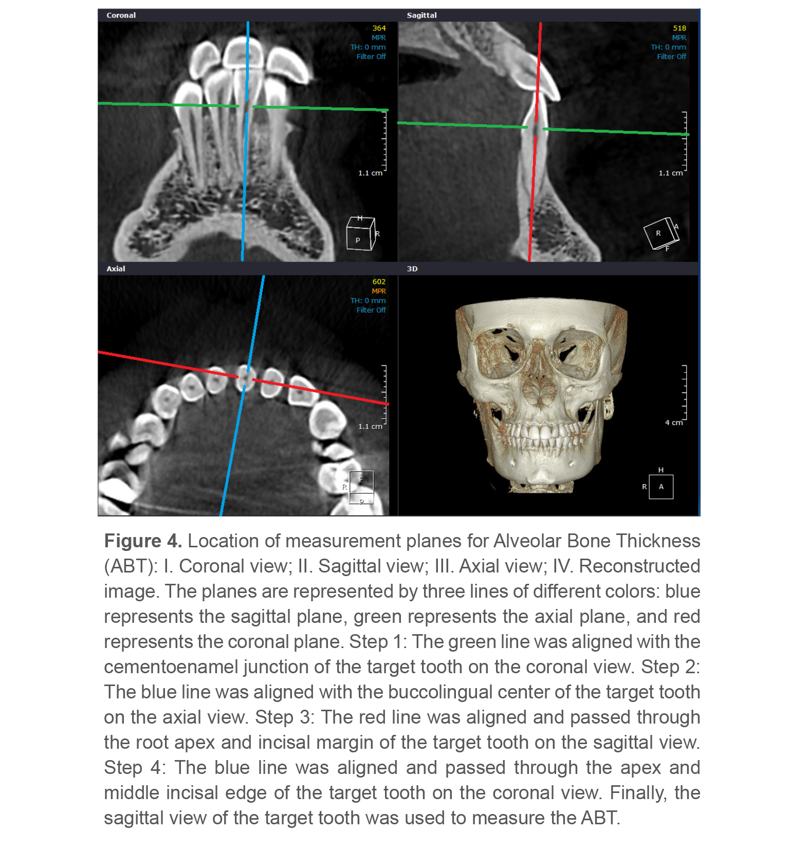 Figure 4. Location of measurement planes for Alveolar Bone Thickness (ABT): I. Coronal view; II. Sagittal view; III. Axial view; IV. Reconstructed image. The planes are represented by three lines of different colors: blue represents the sagittal plane, green represents the axial plane, and red represents the coronal plane. Step 1: The green line was aligned with the cementoenamel junction of the target tooth on the coronal view. Step 2: The blue line was aligned with the buccolingual center of the target tooth on the axial view. Step 3: The red line was aligned and passed through the root apex and incisal margin of the target tooth on the sagittal view. Step 4: The blue line was aligned and passed through the apex and middle incisal edge of the target tooth on the coronal view. Finally, the sagittal view of the target tooth was used to measure the ABT.