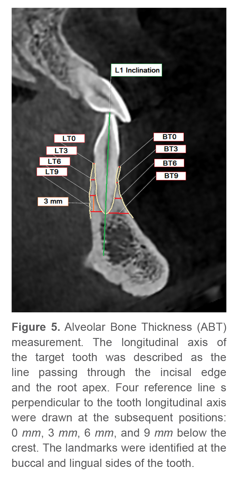 Figure 5. Alveolar Bone Thickness (ABT) measurement. The longitudinal axis of the target tooth was described as the line passing through the incisal edge and the root apex. Four reference line s perpendicular to the tooth longitudinal axis were drawn at the subsequent positions: 0 mm, 3 mm, 6 mm, and 9 mm below the crest. The landmarks were identified at the buccal and lingual sides of the tooth.