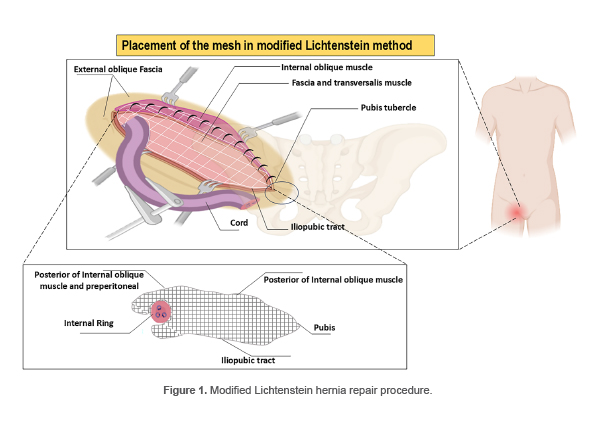 Figure 1. Modified Lichtenstein hernia repair procedure.