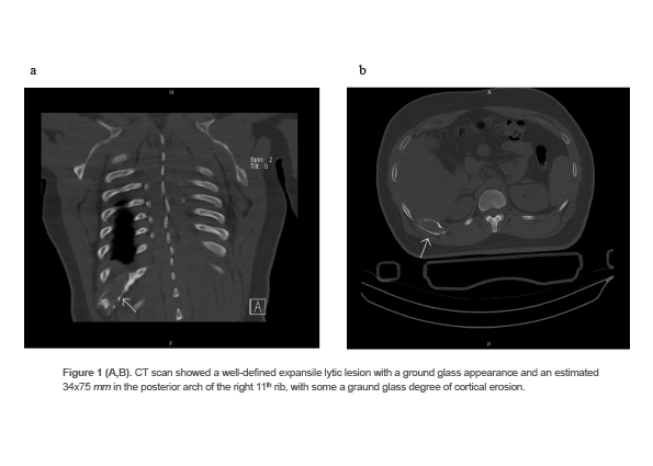 Figure 1 (A,B). CT scan showed a well-defined expansile lytic lesion with a ground glass appearance and an estimated 34x75 mm in the posterior arch of the right 11th rib, with some a graund glass degree of cortical erosion.