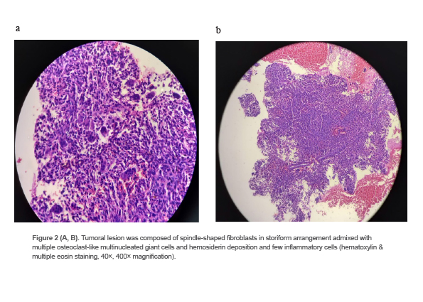 Figure 2 (A, B). Tumoral lesion was composed of spindle-shaped fibroblasts in storiform arrangement admixed with multiple osteoclast-like multinucleated giant cells and hemosiderin deposition and few inflammatory cells (hematoxylin & multiple eosin staining, 40×, 400× magnification).